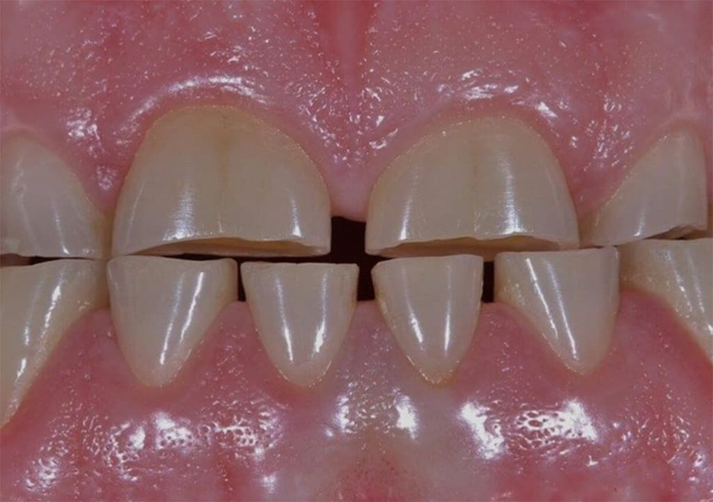 Teeth Grinding