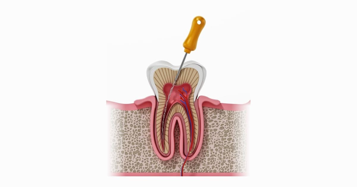 Root Canal Treatment procedure at M S Dental Nest - Dental clinic near Forum Mall South Bengaluru