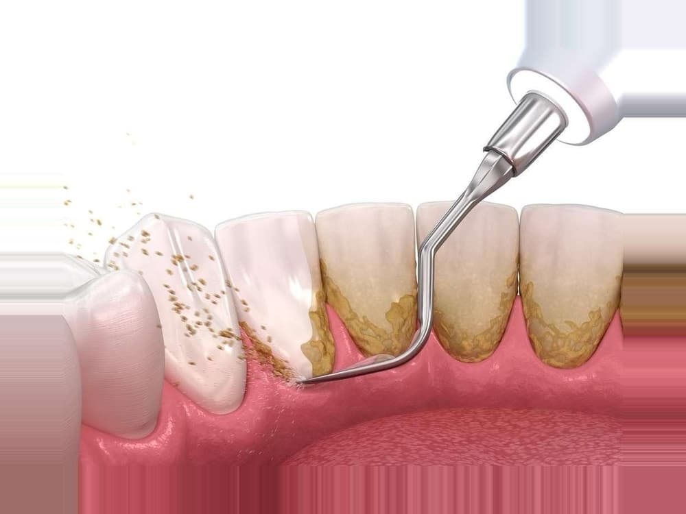 Teeth Cleaning procedure at M S Dental Nest - Dental clinic near Forum Mall South Bengaluru